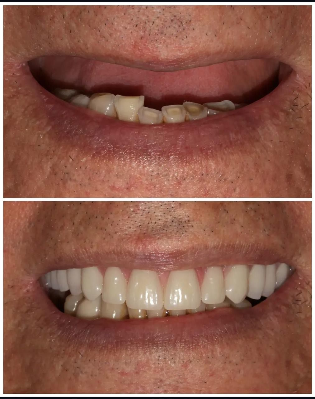 Before and after full-mouth implant rehabilitation — case 1