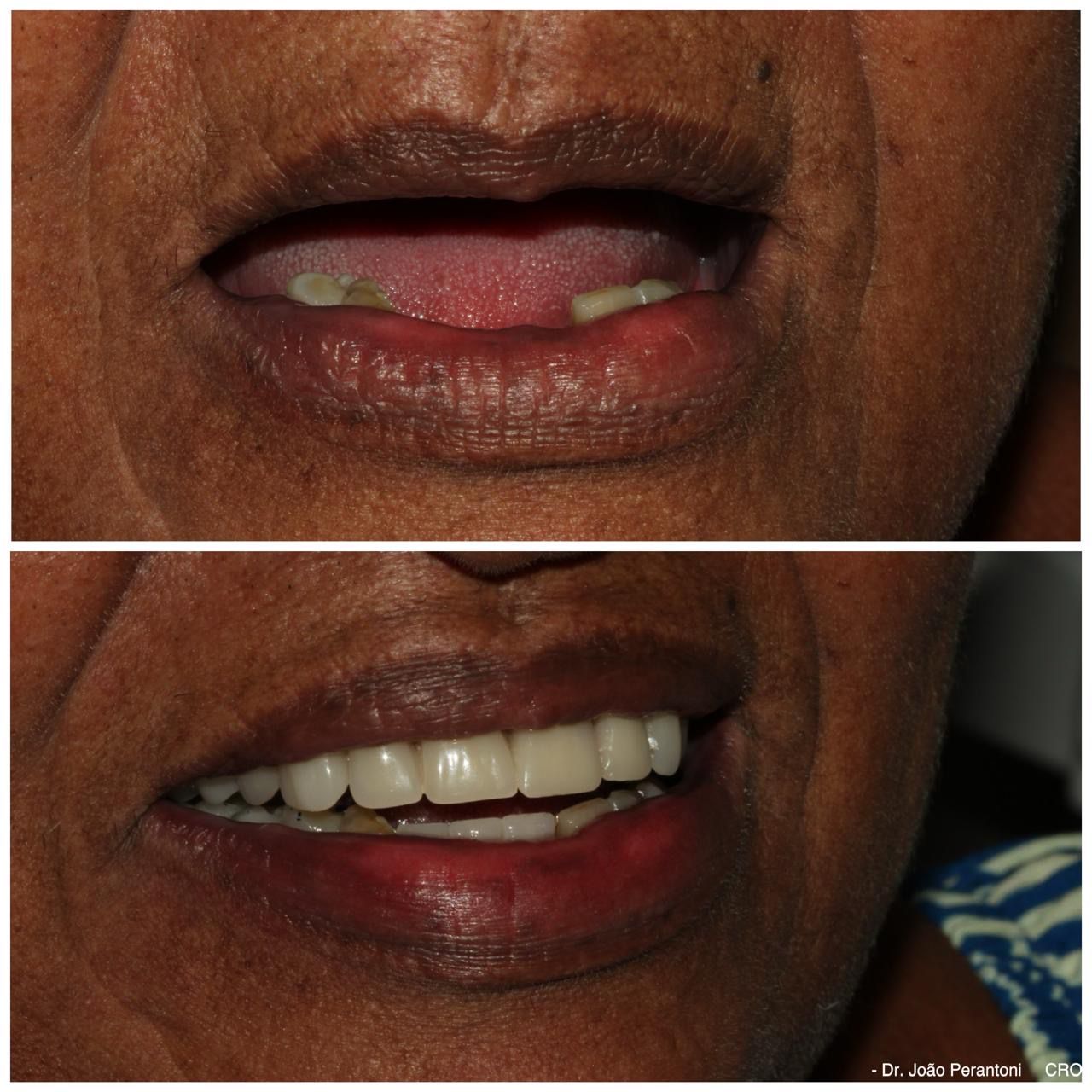 Before and after full-mouth implant rehabilitation — case 3