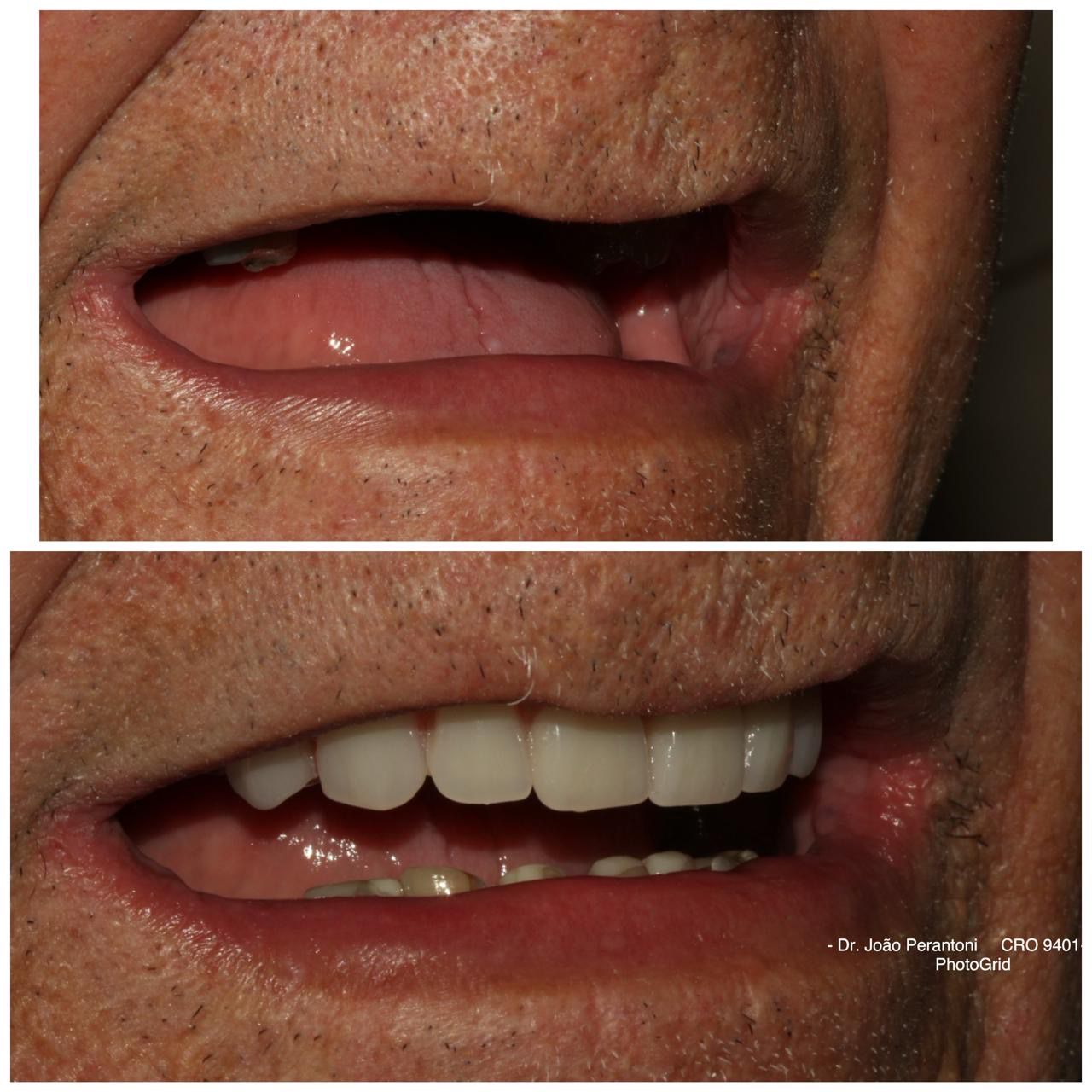 Before and after full-mouth implant rehabilitation — case 4