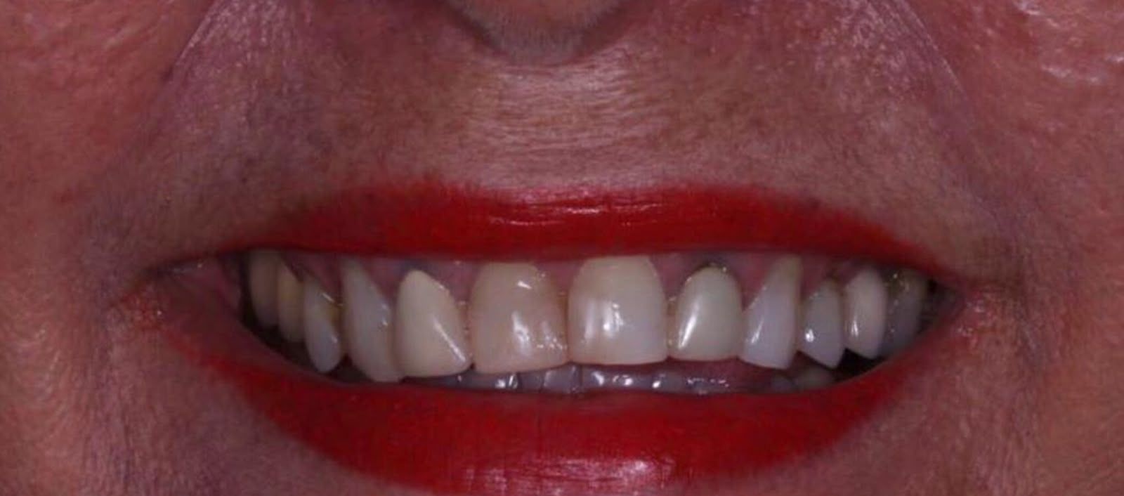 Patient smile before implant dentistry treatment