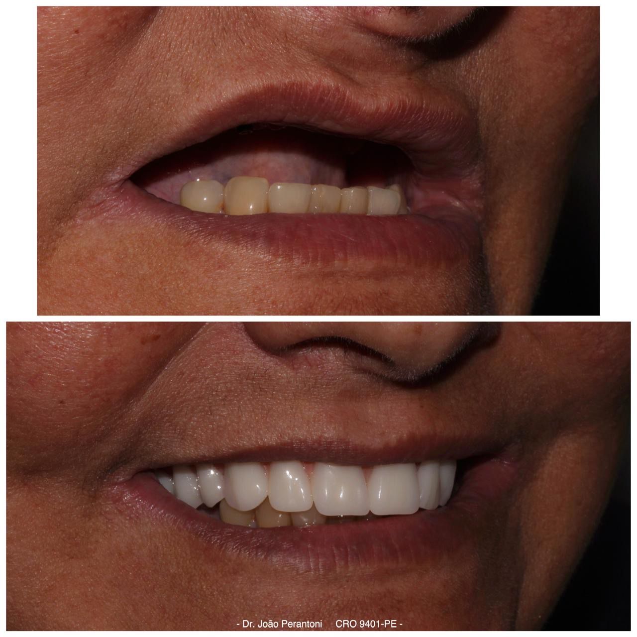 Before and after full-mouth implant rehabilitation — case 2