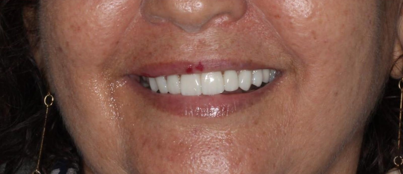 Patient smile after implant dentistry treatment